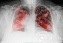 歐洲醫學新發現：免疫細胞新發現有助于開發慢性肺炎療法