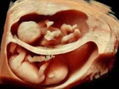 懷了雙胞胎又驚喜又擔憂,唐山寶島婦兒醫院為您保駕護航