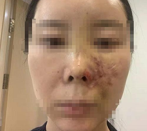 女子在沈陽美萊整形后面部青紫不敢見人 賠償問題未能達成一致-易網健康<a href=http://m.logojc.com/jkys/ target=_blank class=infotextkey>養生</a>網 女子在沈陽美萊整形后面部青紫不敢見人 賠償問題未能達成一致