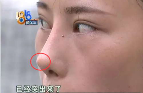 杭州恒麗醫療整形手術7個月后越看越不喜歡 鼻尖凸出來了