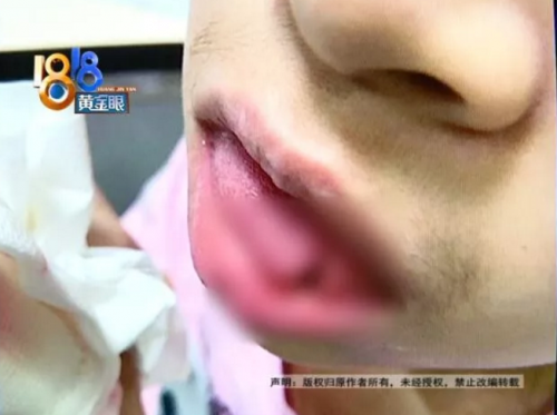 去杭州艾維口腔補牙舌頭被劃傷縫八針 疼的渾身發抖-易網健康<a href=http://m.logojc.com/jkys/ target=_blank class=infotextkey>養生</a>網 去杭州艾維口腔補牙舌頭被劃傷縫八針 疼的渾身發抖