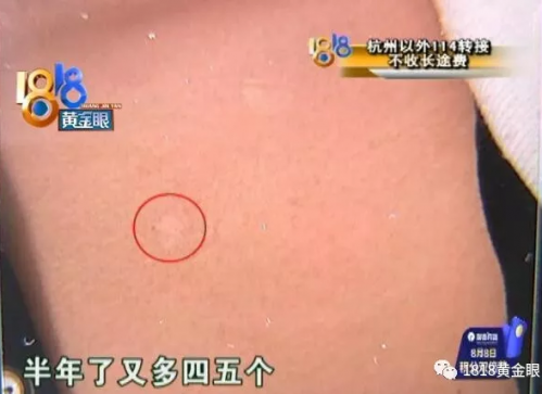 患者在杭州麗都白癜風醫院花冤枉錢?原本只需200元卻花了近六千-易網<a href=http://m.logojc.com/ target=_blank class=infotextkey>健康養生</a>網 患者在杭州麗都白癜風醫院花冤枉錢?原本只需200元卻花了近六千