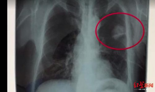 玉佩致胸片陰影誤診？四川勞研科技有限公司體檢顯示正常 男子一年后去世