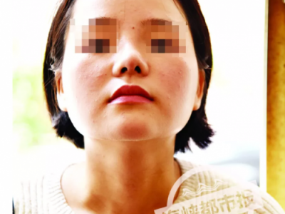 泉州東大整形醫(yī)院被投訴：女子花4.4萬整容 鼻子歪成這樣