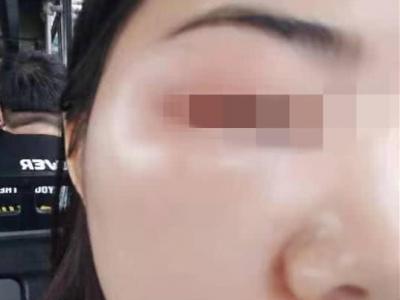 女子在宜賓韓美整形后差點毀容 醫(yī)院：個體差異