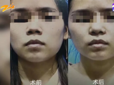 杭州甄美整形醫院把人鼻子整歪了？醫院：自己長歪了