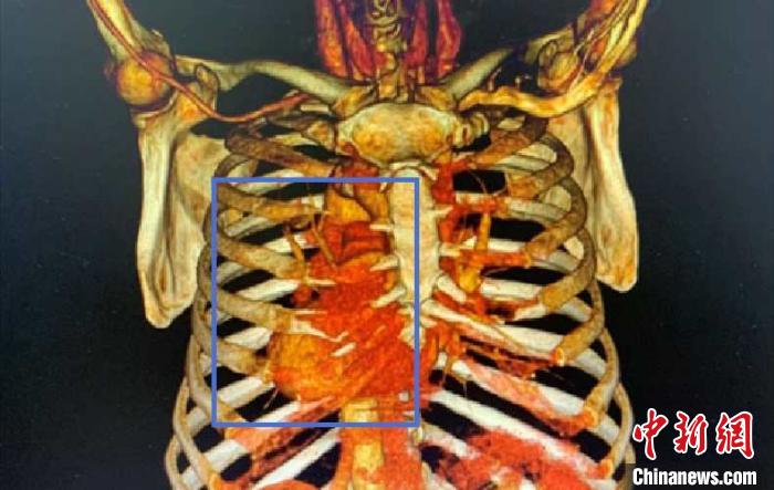 上海專家獨辟新徑成功救治天生“異”心人