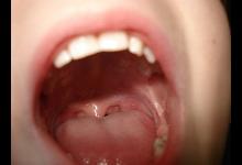 嘴巴爛了是什么原因