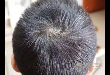 早生華發，試試枸杞，能幫你找回黑發