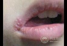 吃這些食物讓你嘴巴不上火起泡！