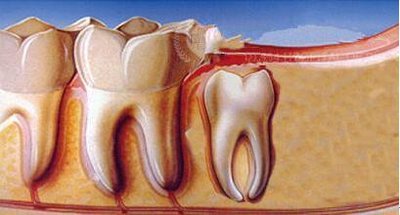 拔了盡頭牙也就是智齒要注意什么 拔了盡頭牙也就是智齒要注意什么