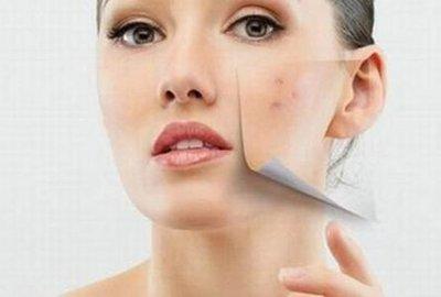 臉上長的痘痘開始發(fā)紫是什么情況