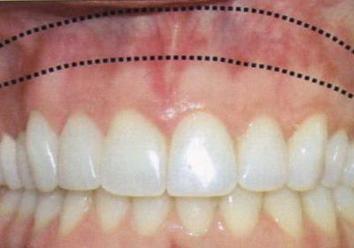 牙齦壞了的治療方法以及應該如何修復牙齦