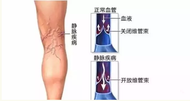 喝酒是否會(huì)影響到靜脈曲張患者的健康