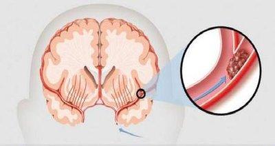 腦梗塞一旦出現(xiàn)應(yīng)該如何按摩頭部