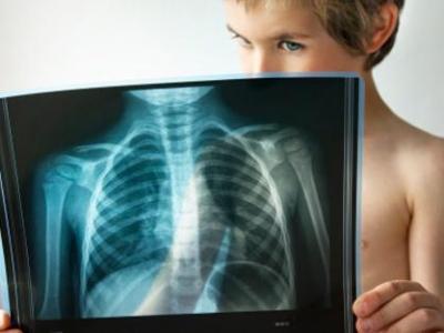 孕婦是否可以拍胸片會不會有輻射