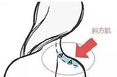 斜方肌可以通過按摩的方式消除嗎