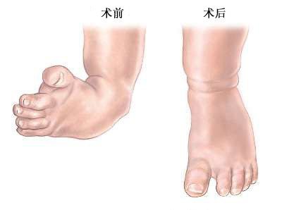 導致孩子足內翻的因素以及改善方法