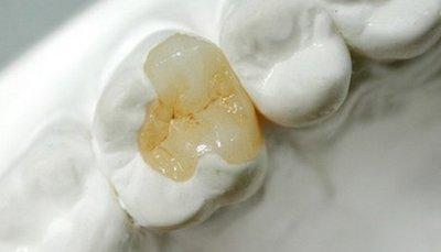 補完牙齒之后過多久可以開始吃東西