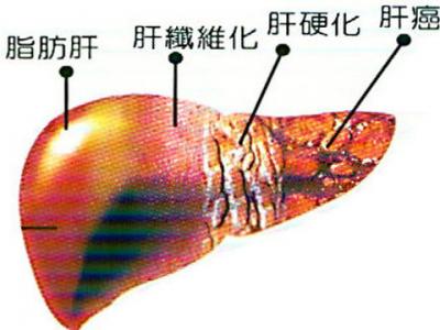 脂肪肝前期表現以及脂肪肝的預防方法