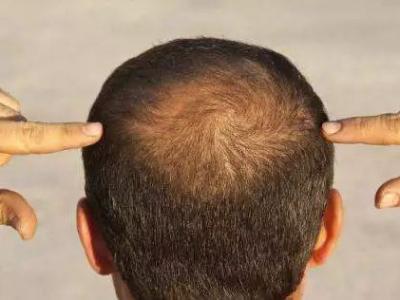 我們需要警惕脂溢性脫發存在的危害