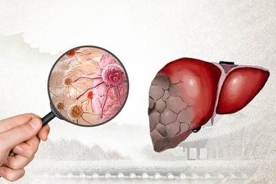 肝病有哪些病肝病具體分為哪些種類-易網健康<a href=http://m.logojc.com/jkys/ target=_blank class=infotextkey>養生</a>網 肝病有哪些病肝病具體分為哪些種類
