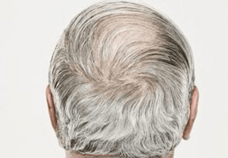 以下幾種方法有效幫你白頭發(fā)變黑