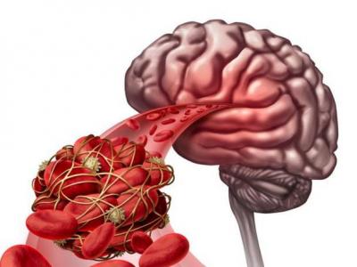 腦中風突然發作如何正確的進行急救