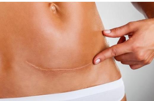 孕婦在生產過程中什么情況可以進行剖腹產手術