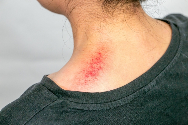 濕氣重拔罐還是刮痧好 刮痧怎么看出濕氣重-易網健康<a href=http://m.logojc.com/jkys/ target=_blank class=infotextkey>養生</a>網 濕氣重拔罐還是刮痧好 刮痧怎么看出濕氣重