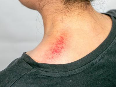 濕氣重拔罐還是刮痧好 刮痧怎么看出濕氣重