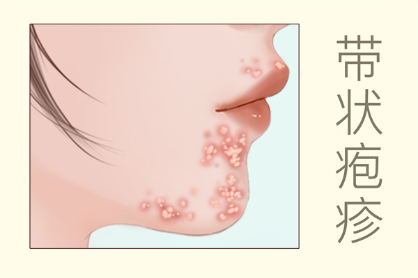 帶狀皰疹能吃羊肉嗎