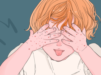 絲蟲病分類有哪些?