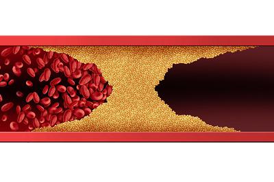膽固醇高說白了就是缺蛋白質嗎 導致膽固醇高的三大原因