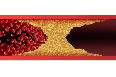 血管堵了自己有感覺嗎 血液病的三大預(yù)警信號