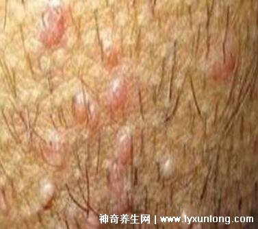 初期尖銳濕尤圖癥狀圖片男性,淡紅色小疙瘩變大為菜花狀疣體-易網健康<a href=http://m.logojc.com/jkys/ target=_blank class=infotextkey>養生</a>網 初期尖銳濕尤圖癥狀圖片男性,淡紅色小疙瘩變大為菜花狀疣體