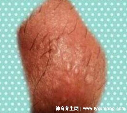 初期尖銳濕尤圖癥狀圖片男性,淡紅色小疙瘩變大為菜花狀疣體-易網健康養生網 初期尖銳濕尤圖癥狀圖片男性,淡紅色小疙瘩變大為菜花狀疣體