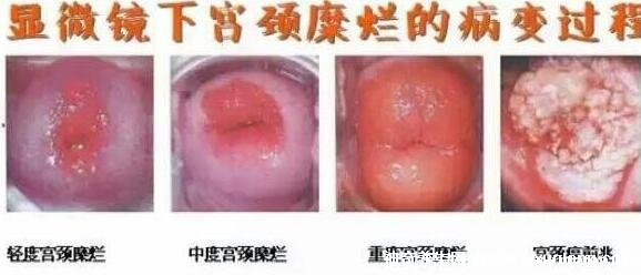 宮頸糜爛一二三度圖片,真實(shí)對(duì)比照片(小心是宮頸癌前兆)-易網(wǎng)健康<a href=http://m.logojc.com/jkys/ target=_blank class=infotextkey>養(yǎng)生</a>網(wǎng) 宮頸糜爛一二三度圖片,真實(shí)對(duì)比照片(小心是宮頸癌前兆)