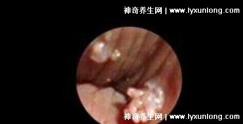 初期尖銳濕尤圖癥狀圖片男性,淡紅色小疙瘩變大為菜花狀疣體-易網健康養生網 初期尖銳濕尤圖癥狀圖片男性,淡紅色小疙瘩變大為菜花狀疣體