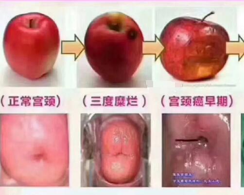 宮頸糜爛一二三度圖片,真實(shí)對(duì)比照片(小心是宮頸癌前兆)-易網(wǎng)健康養(yǎng)生網(wǎng) 宮頸糜爛一二三度圖片,真實(shí)對(duì)比照片(小心是宮頸癌前兆)