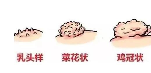 初期尖銳濕尤圖癥狀圖片男性,淡紅色小疙瘩變大為菜花狀疣體-易網<a href=http://m.logojc.com/ target=_blank class=infotextkey>健康養生</a>網 初期尖銳濕尤圖癥狀圖片男性,淡紅色小疙瘩變大為菜花狀疣體