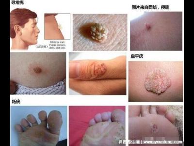 用了甲硝唑后里面長滿了霉菌，破壞有益菌群/衛(wèi)生不佳(附治療法)