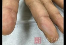 手指挫傷 做好幾點預防手指受傷