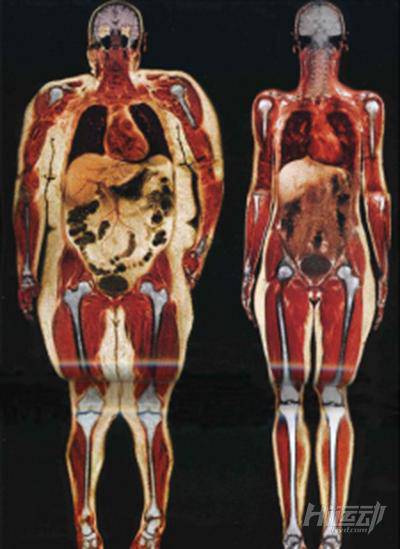 有研究表明肥胖能影響多種疾病，看完你還敢“胖”嗎？