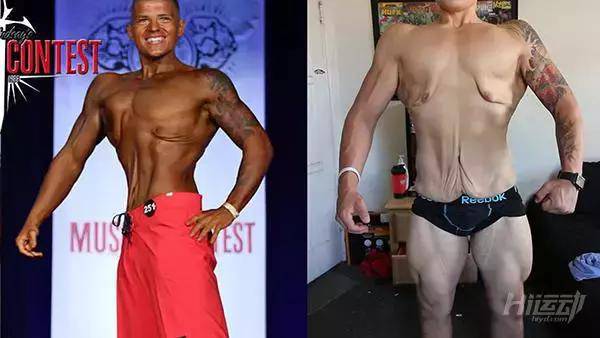 胖子成功減肥200斤，皮膚松弛也坦然面對！