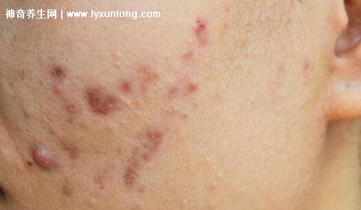 閉口粉刺真正的圖片,粗糙的顆粒會發炎長膿皰(黑頭也是粉刺)-易網健康養生網 閉口粉刺真正的圖片,粗糙的顆粒會發炎長膿皰(黑頭也是粉刺)