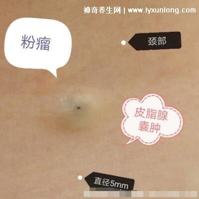 閉口粉刺真正的圖片,粗糙的顆粒會發炎長膿皰(黑頭也是粉刺)-易網健康養生網 閉口粉刺真正的圖片,粗糙的顆粒會發炎長膿皰(黑頭也是粉刺)