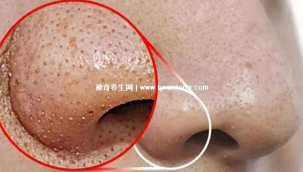 閉口粉刺真正的圖片,粗糙的顆粒會發炎長膿皰(黑頭也是粉刺)-易網健康<a href=http://m.logojc.com/jkys/ target=_blank class=infotextkey>養生</a>網 閉口粉刺真正的圖片,粗糙的顆粒會發炎長膿皰(黑頭也是粉刺)