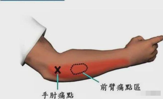 網(wǎng)球肘最怕三個動作,反手拍球/手腕彎曲/提重物/做家務(wù)-易網(wǎng)健康<a href=http://m.logojc.com/jkys/ target=_blank class=infotextkey>養(yǎng)生</a>網(wǎng) 網(wǎng)球肘最怕三個動作,反手拍球/手腕彎曲/提重物/做家務(wù)