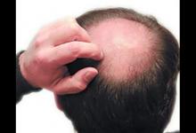 聰明絕頂？禿頂這件事 為何傳男不傳女？